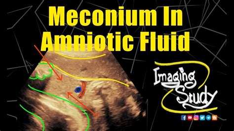 straw colored amniotic fluid|Meconium